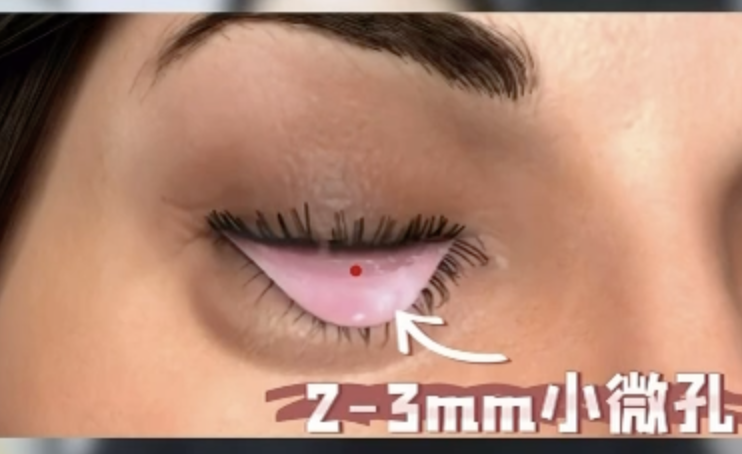 2-3mm micro-hole entry point on inner lower eyelid