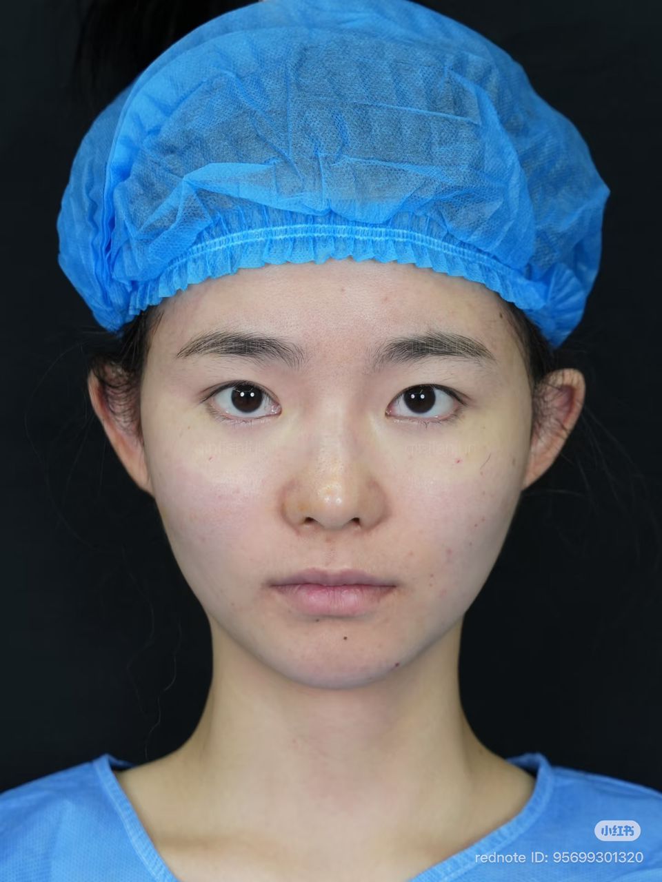 After: smooth under-eye contour, tear trough filled, rested look