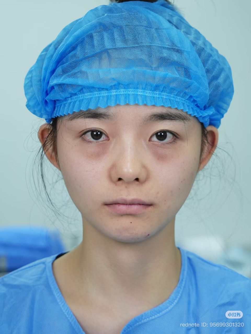 Another patient before eyebag removal — visible under-eye bags