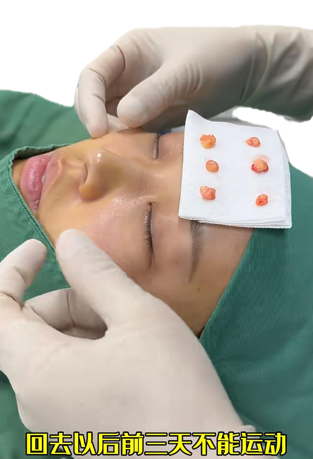 Extracted fat pads on gauze after removal through micro-hole