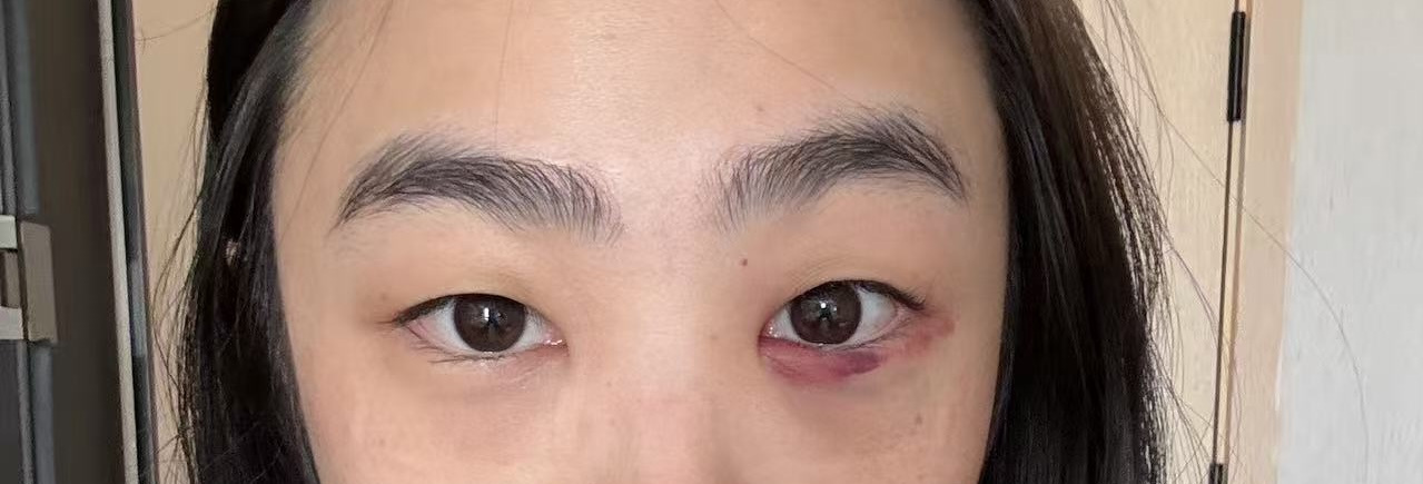 2 days after eyebag removal: bruising under one eye