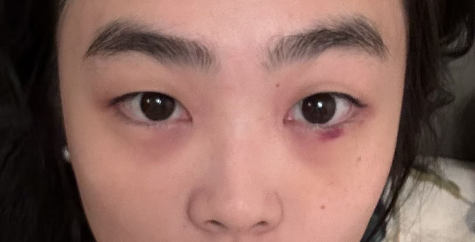 5 days after eyebag removal: bruising fading, swelling reducing