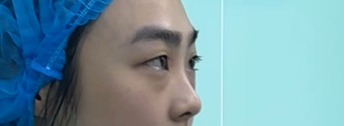 Side profile showing eye bag prominence before procedure