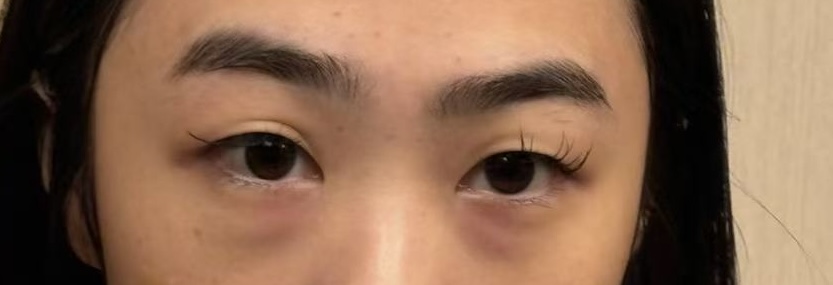 Close-up: hereditary under-eye bags with no makeup