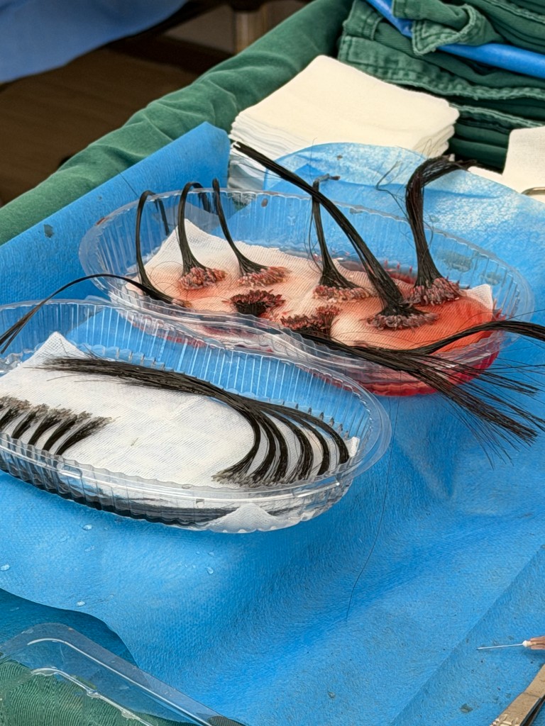 Reference: two trays of long-hair FUE grafts on gauze during surgery.