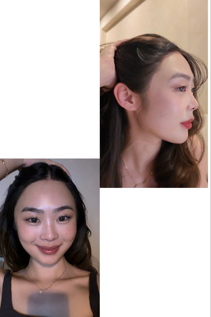 After hair transplant: frontal portrait and side profile.