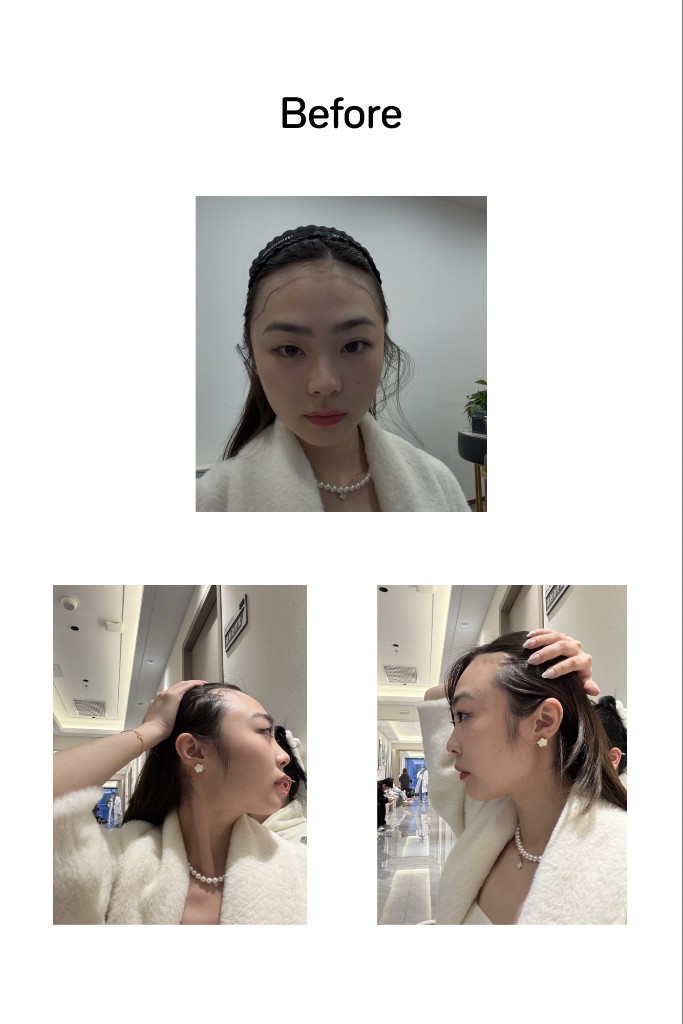 Before hair transplant: hospital documentation photos.