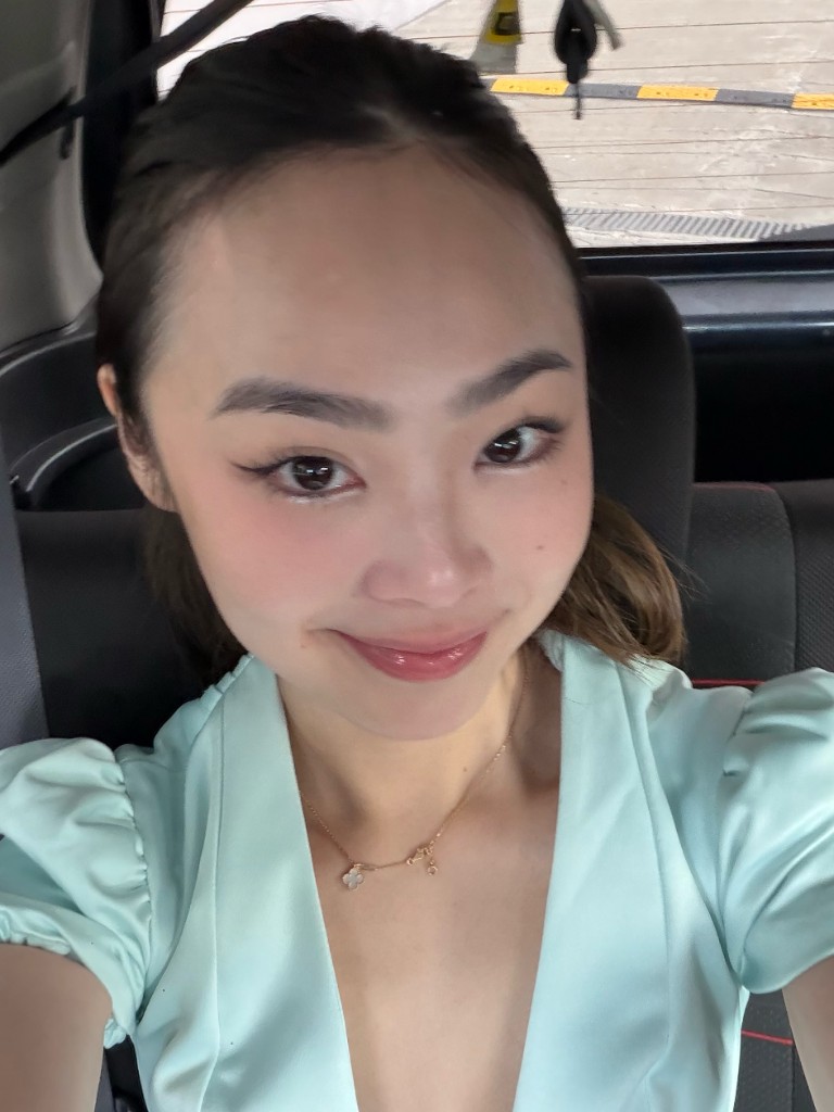 Before surgery: selfie with hair pulled back, showing high forehead and hairline.